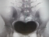 Xray-What-a-Black-Heart-Becomes